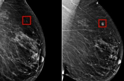 Promising Study Shows Ribociclib Reduces Breast Cancer Recurrence Risk in Early-Stage Patients
